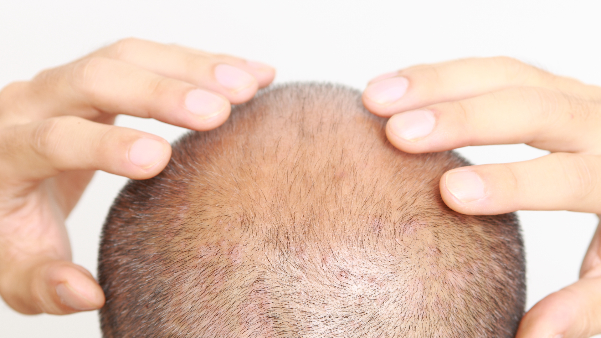 All Hair Loss Solutions to Get Your Hair Back